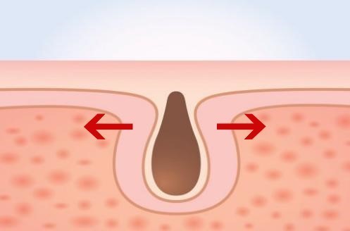 pores-2_w500.jpg