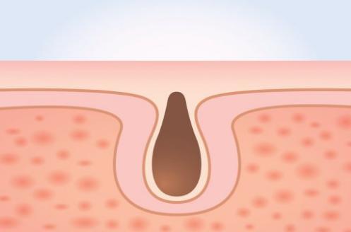 pores_w500.jpg